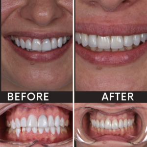 Teeth transformation