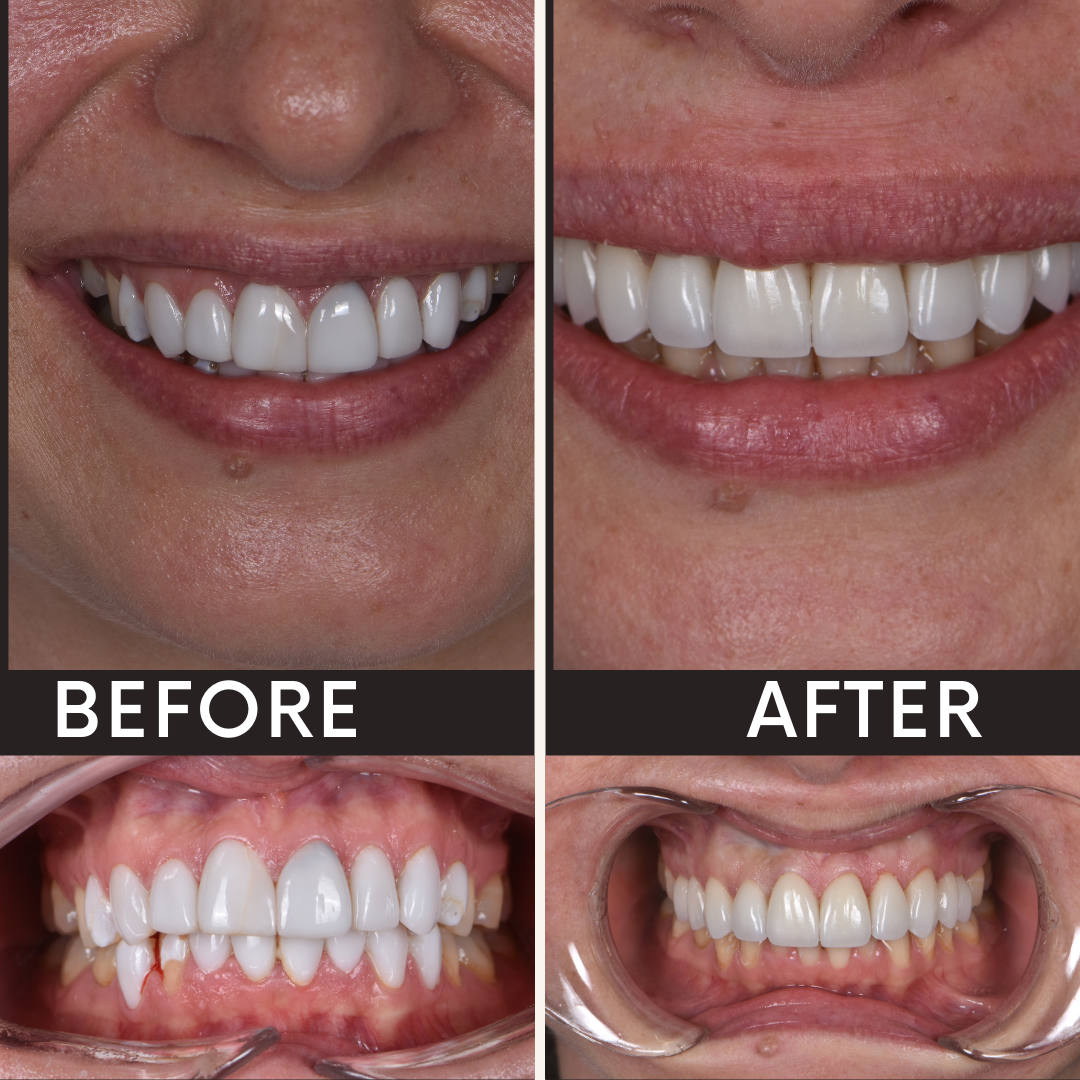 Teeth transformation