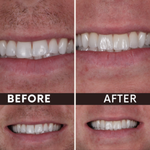 Smile transformation